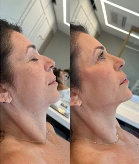 Antes e depois — harmonização facial