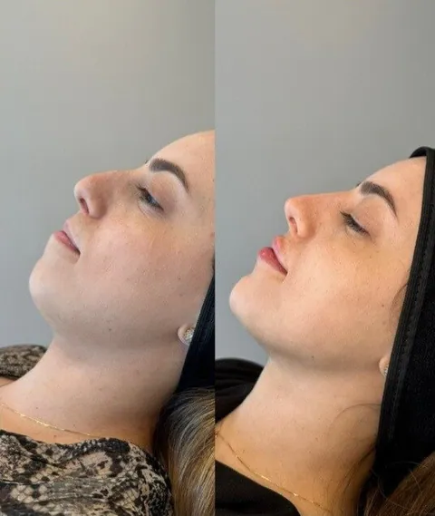 Antes e depois — toxina e volumização