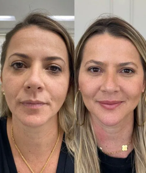 Antes e depois — bioestimulador de colágeno