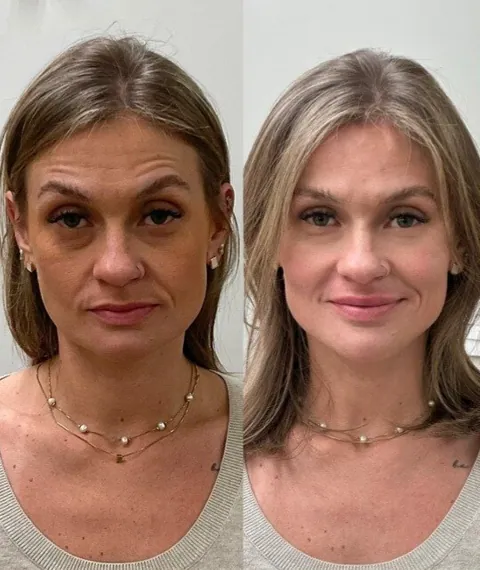 Antes e depois — lábios e contorno